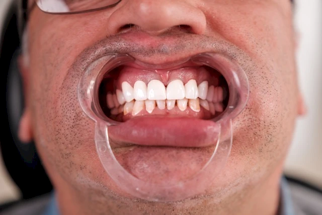 Что такое лечение корневых каналов?