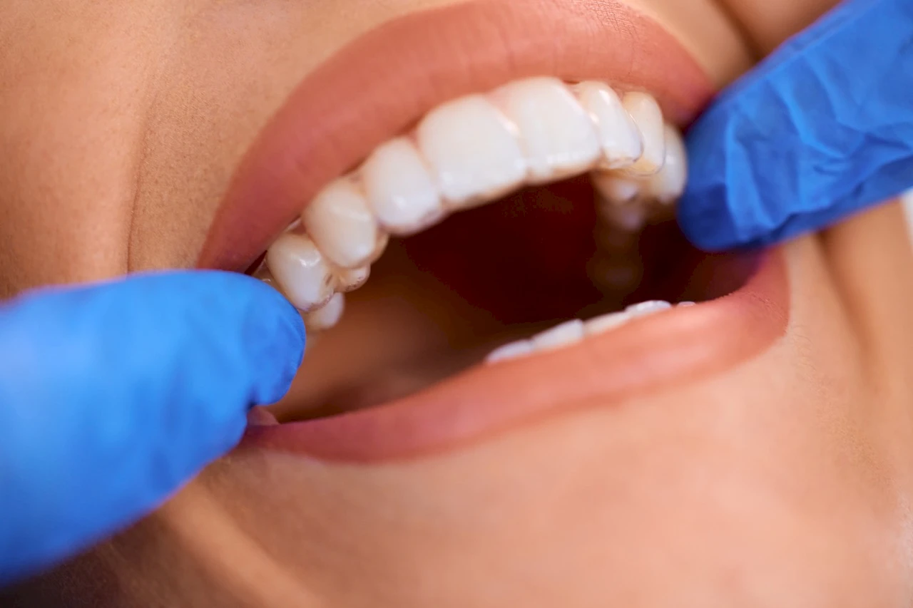 Achieve a Radiant Smile with Porcelain Veneers: A Comprehensive Guide by Özel Beyaz Diş